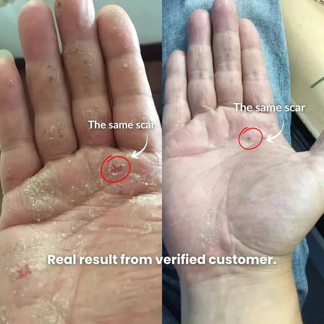 SpiroPlus (Natural Eczema & Psoriasis Solution Backed by Gut Science - Trusted in Malaysia) - ECZEMAHERO